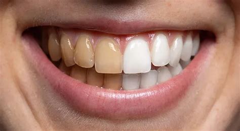 Understanding the Potential Risks and Side Effects of Teeth Whitening