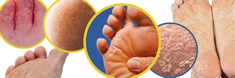 Understanding the Reasons: What Triggers Peeling Epidermis on the Feet? 