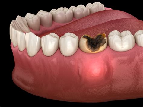 Understanding the Role of Tooth Infections in Swelling