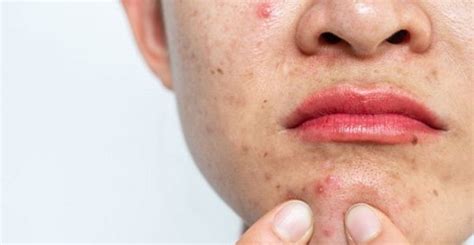 Understanding the Science Behind Enormous Pimples