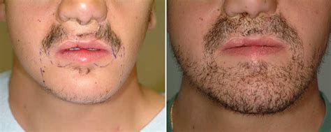 Understanding the Science behind Facial Hair Growth