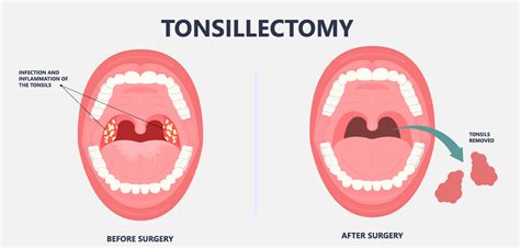 Understanding the Significance of Tonsil Extraction