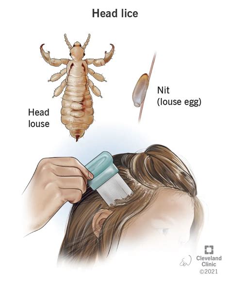 Understanding the Telltale Signs of Body Lice