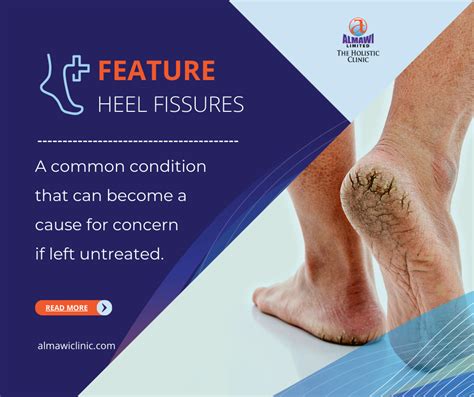 Understanding the underlying factors behind heel fissures