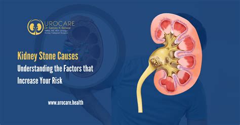 Unraveling the Formation Factors of Kidney Stones