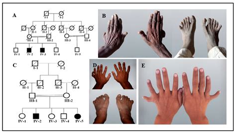 Unraveling the Science of Polydactyly: Exploring Five-Fingered Chimeras