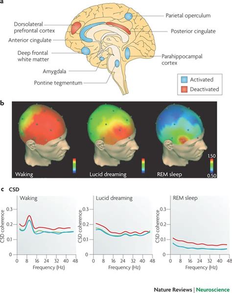 Unraveling the Scientific Insight into Dreaming Phenomena in Patients with Irreversible Brain Dysfunction