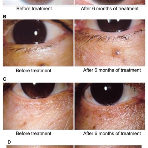 Unraveling the Truth behind Techniques to Alter Iris Pigmentation