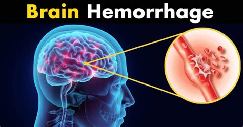 Unveiling the Causes of Cerebral Hemorrhage