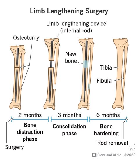 Unveiling the Meaning behind Dreams Involving Surgical Procedures on the Upper Limb