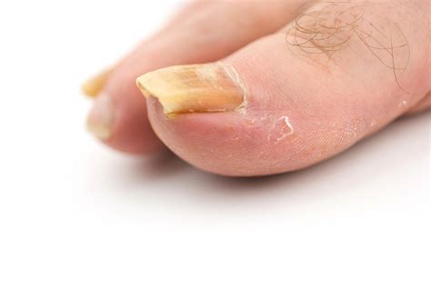 Unveiling the Potential Health Issues Associated with Envisioning Deteriorating Toenail Condition