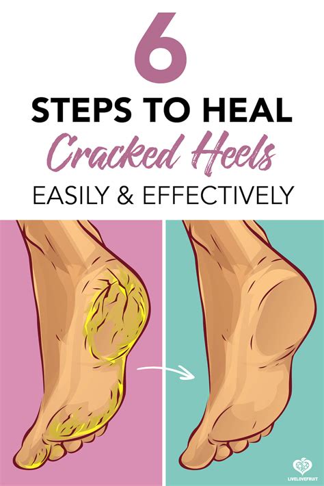 Unveiling the Role of Diet in Healing Cracked Heels