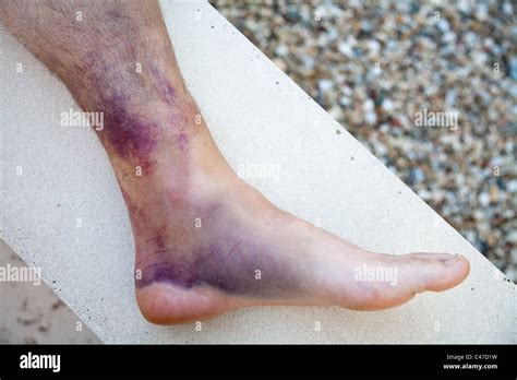 Unveiling the Symbolic Significance of Bruised Feet in Different Cultures