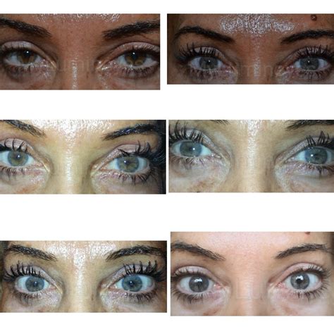 Unveiling the Trend of Procedures for Altering Eye Pigmentation