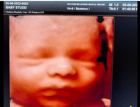 Unveiling the Wonders of 3D and 4D Sonograms