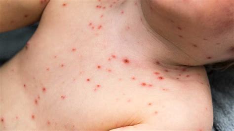 Viral Causes of Rashes: Exploring Measles, Chickenpox, and More