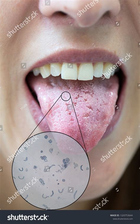 Viral Infections: Common Culprits for Tongue Infection