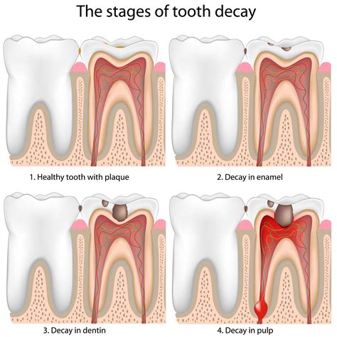 What Leads to the Development of Cavities in Teeth?