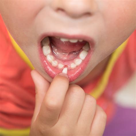 What to Expect After Your Child's Tooth Comes Loose