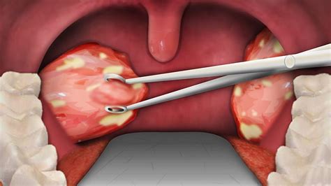 When is Tonsil Extraction Recommended?