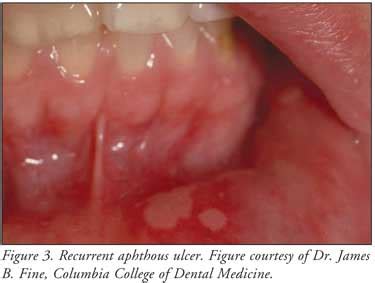 When to Seek Medical Attention for Oral Lesions