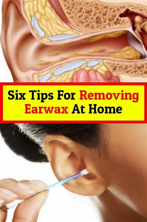 When to Seek Professional Help for Removing Ear Wax