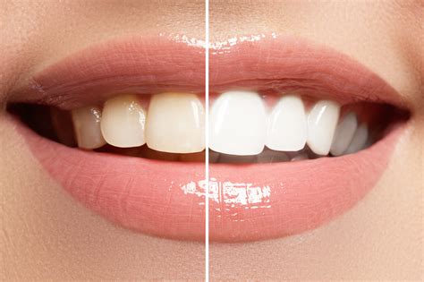 Yearning for Radiant, Pearly Whites: Unraveling the Factors Behind Discolored Teeth