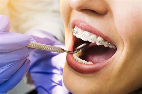 Your Oral Health Matters: How Braces Removal Can Improve Your Overall Well-being